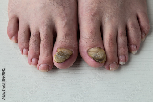 nail fungus care or nail fungus treatment. medical concept. 