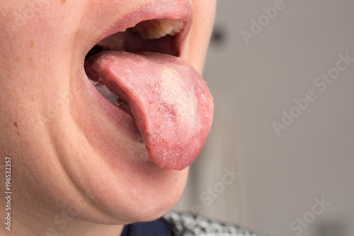 Oral trush on woman tongue photo