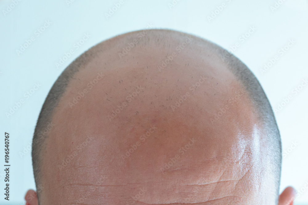 Fototapeta premium View of bald man's head