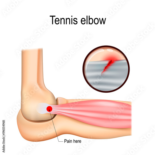 Tennis elbow or lateral epicondylitis.