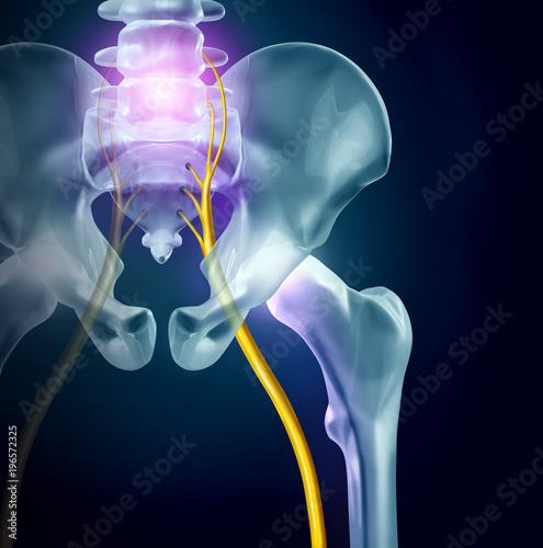 Sciatica Pain photo