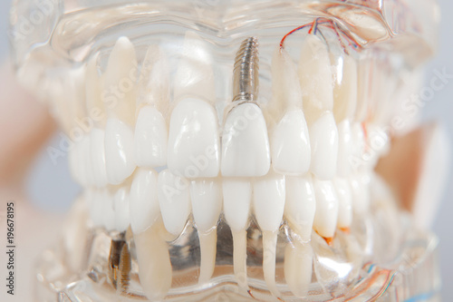 Jaw breadboard. Orthodontist teeth have been capped and stainless pin in gums.