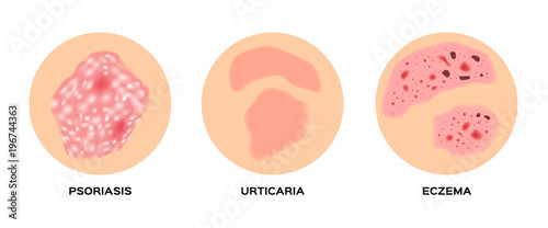 skin disease vector / psoriasis , urticaria , eczema
