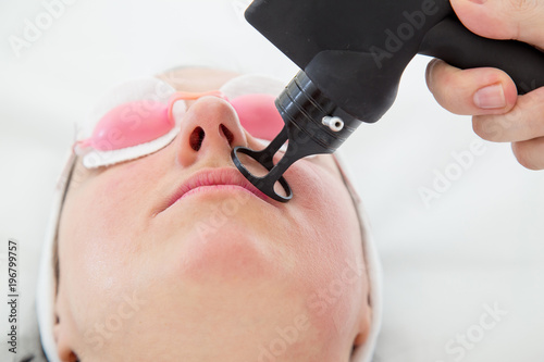 Zabieg laserem frakcyjnym CO2. Medycyna estetyczna. 