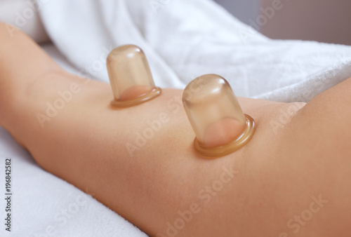 The masseur makes massage with jars of cellulite on the buttock and thighs of the patient. Treatment of excess weight.