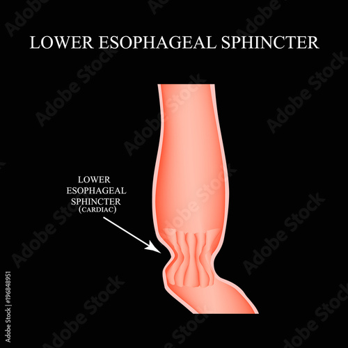 Lower cardiac esophageal sphincter. Infographics. Vector illustration on black background.