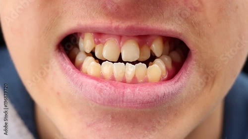 Crooked, crowded, and protruding teeth. A malocclusion happens when mismatched teeth and the jaw cause a person to have a bad bite photo