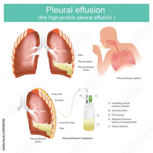 Pleural effusion the high-protein pleural effusion. photo