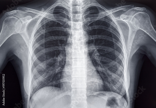 Chest x-ray of an adult female human photo