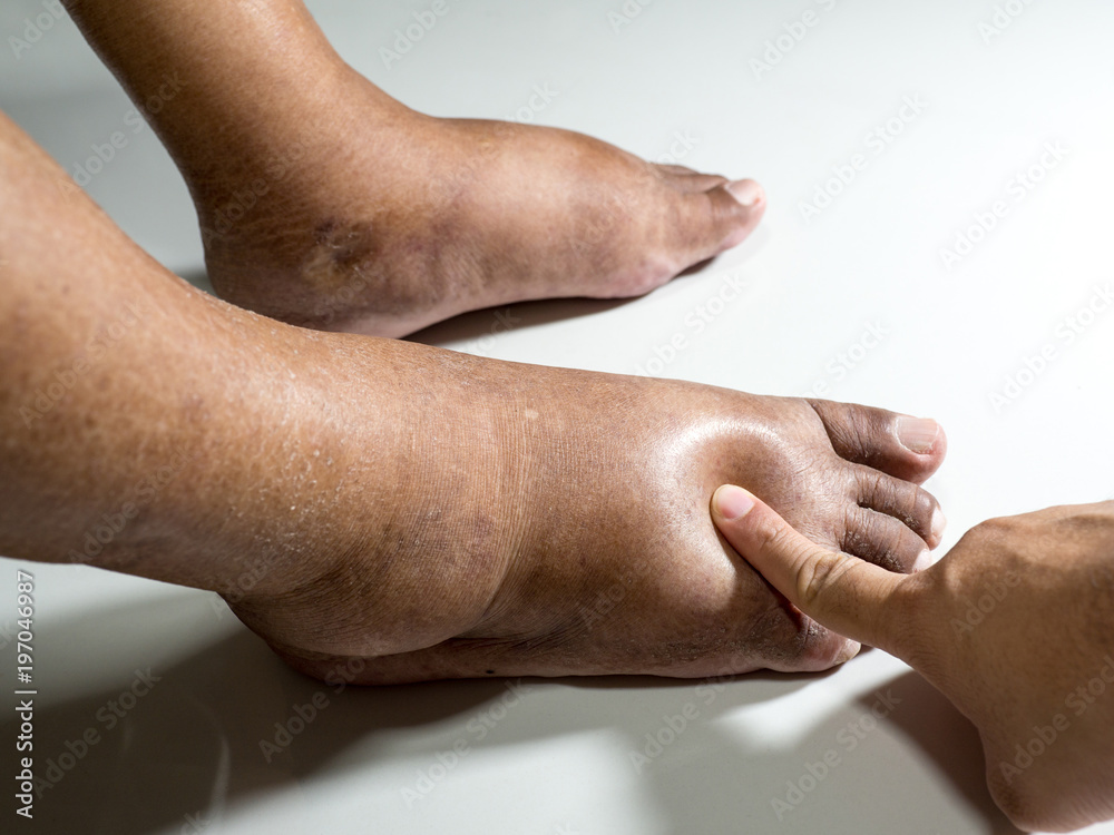 Fototapeta premium The feet of people with diabetes, dull and swollen. Due to the toxicity of diabetes placed on a white background. Fingers hit the back of the diabetic foot. To test foot swelling.