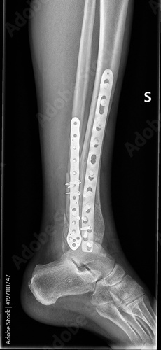 Radiografia caviglia, rottura tibia e perone