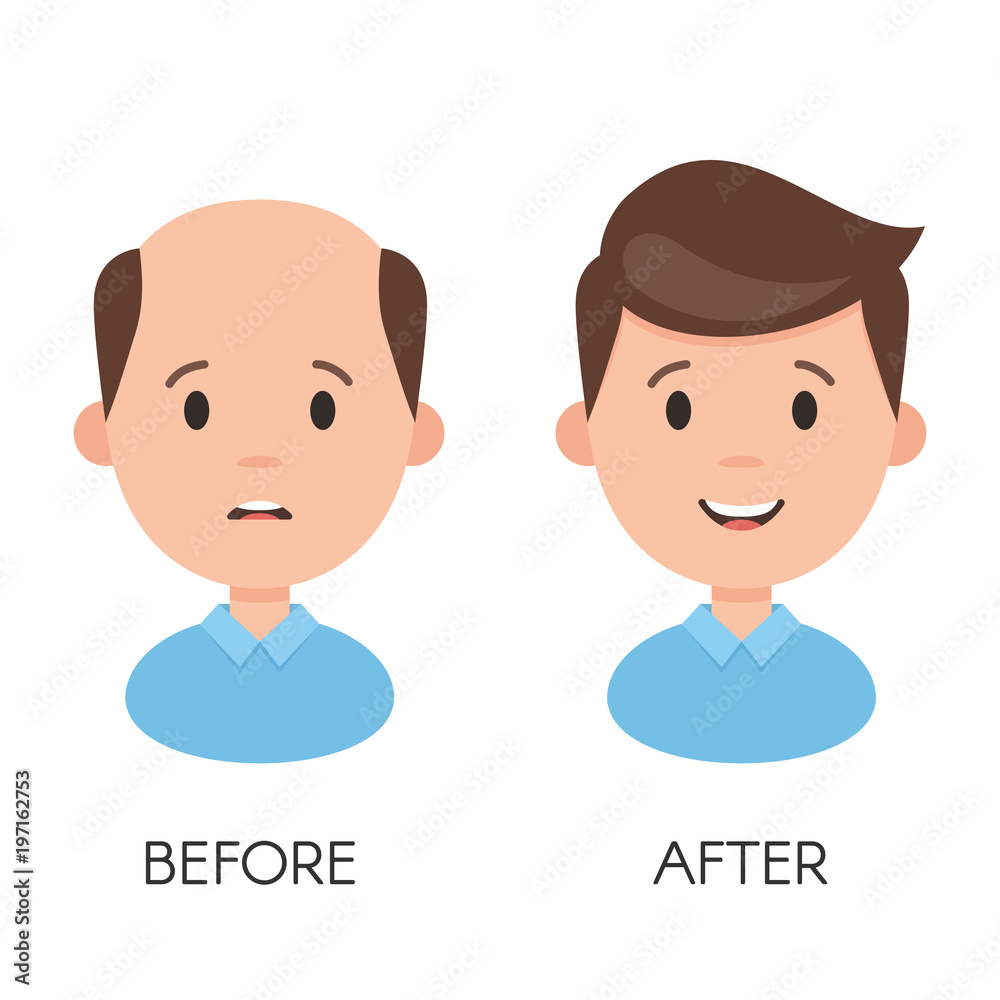 Male hair loss. Man with alopecia problem before and after hair treatment  and transplantation. Vector illustration isolated on white background Stock  Vector | Adobe Stock