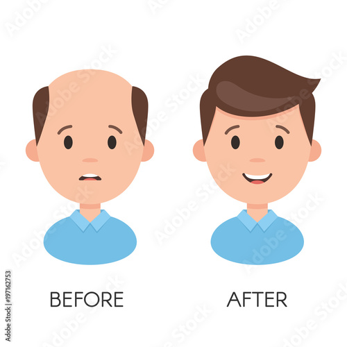 Male hair loss. Man with alopecia problem before and after hair treatment and transplantation. Vector illustration isolated on white background