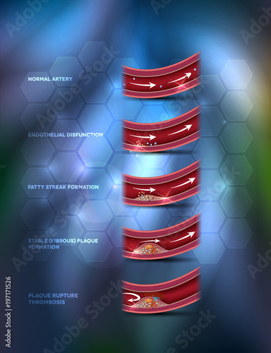 Blood clot formation on an abstract background. Atherosclerosis progression, narrowed artery and at the end blood clot block artery