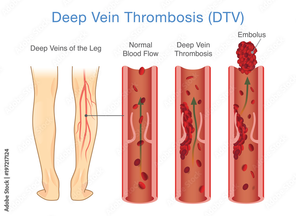 Medical Diagram of Deep Vein Thrombosis at leg area. Illustration about abnormally of blood floow. - obrazy, fototapety, plakaty 