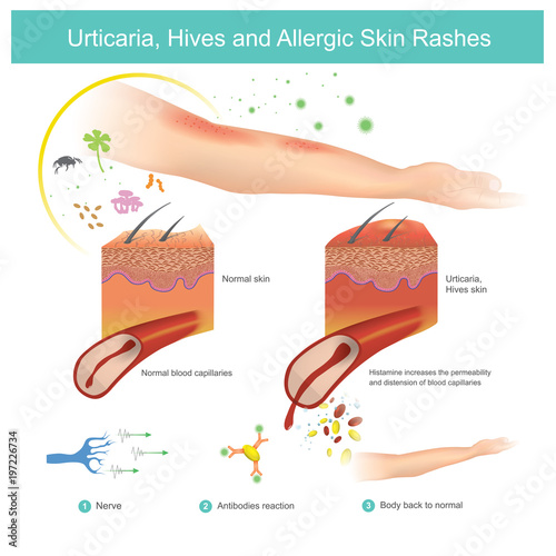Urticaria, Hives and Allergic Skin Rashes. Illustration.