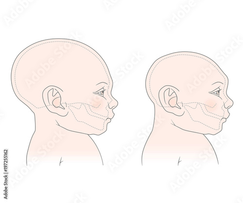 Comparative anatomical image of the head and skull of a newborn child with a normal cranium and with microcephaly. The virus of Zika.  Isolated on white background © iuliiawhite