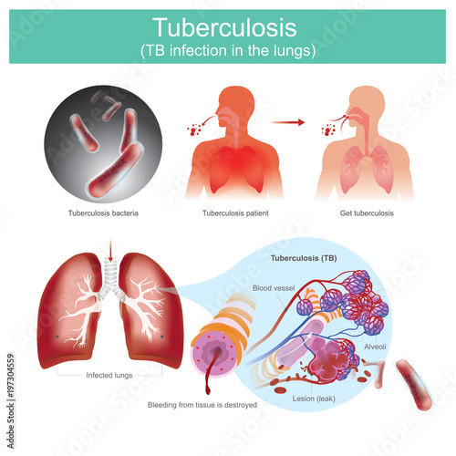 Tuberculosis TB infection in the lungs.