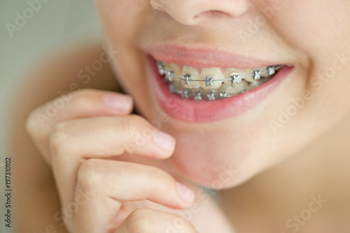 Girl with braces 