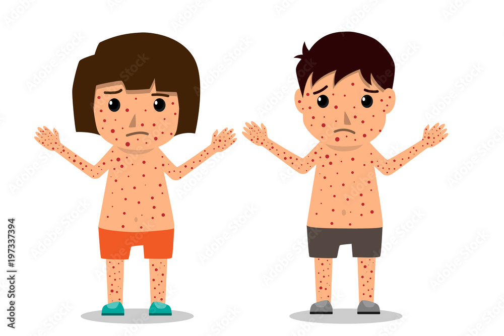 Children has chicken pox infographic, Poster children fever and