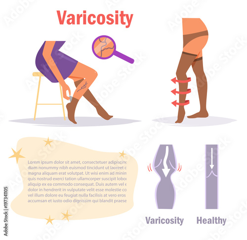 Varicosity. Legs. Vector.