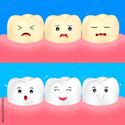 Cute cartoon white and yellow teeth. Before and After, whitening oral care concept.  Dental veneers on human tooth. Deep cleaning, clearing tooth process. Illustration on blue background.