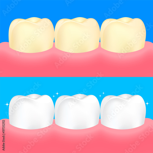 Dental veneers on human tooth.  Before and After, whitening oral care concept. Deep cleaning, clearing tooth process. Illustration on blue background.