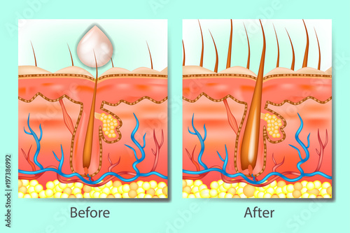 Hair growth stimulants before after. Hair on scalp before and after of treatment hair loss.