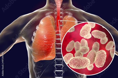 Whooping cough bacteria Bordetella pertussis in human airways photo