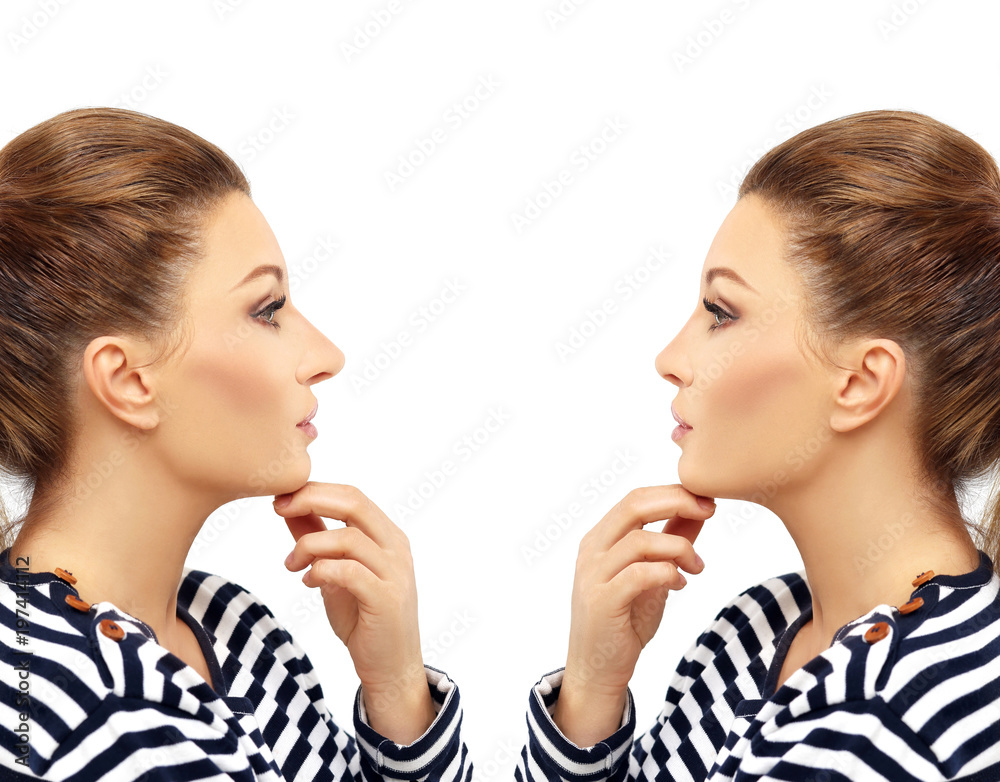 Rhinoplasty.Before and after Rhinoplasty.Before and after