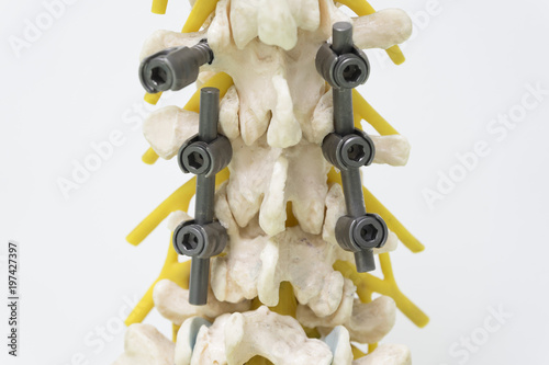 Konstfotografi Model of instrument fixation of lumbar spine