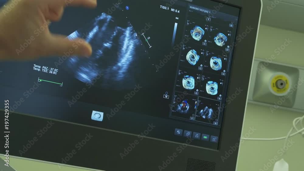dettagli del cuore visti sul monitor di un pc in un reparto di cardio chirurgia
