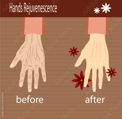Hands care, before after effect, vector illustration for cosmetology