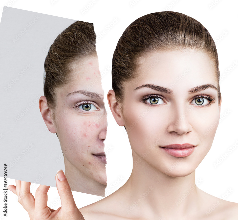 Φωτογραφία Compare of old photo with acne and new healthy skin.