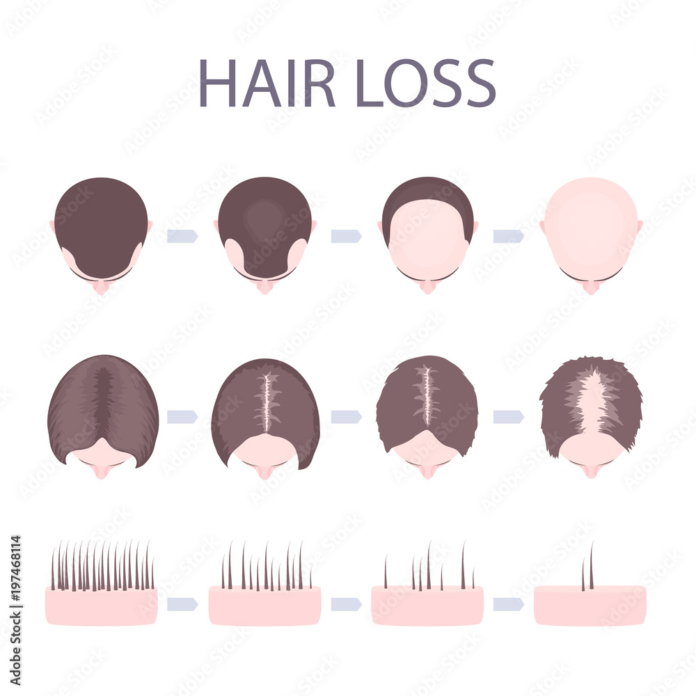 All 30+ Photos difference between male and female hair growth Sharp All 30+ Photos difference between male and female hair growth Sharp