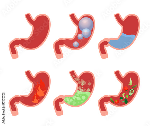 Vector illustration cartoon set medical illustrations of Abdominal bloated stomach. Different types of stomach sickness. Gas, alcohol, swelling, heartburn, food and water inside stomach.