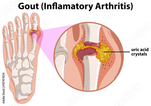 Diagram showing gout in human foot photo