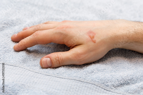 Slika na platnu Burn blister on the hand in the hospital