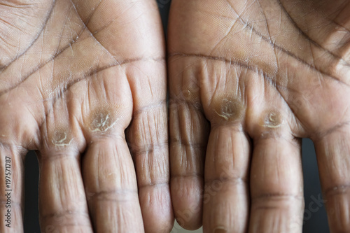 Bild auf Leinwand Closeup of calloused black hands