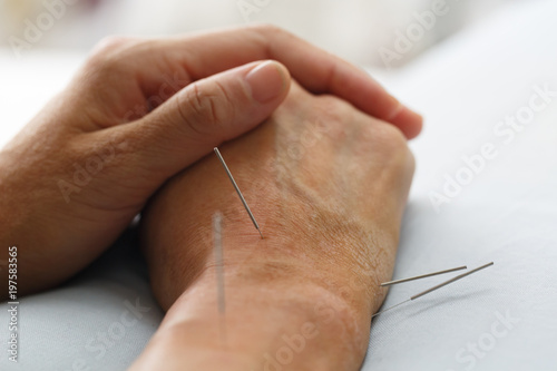 acupuncture