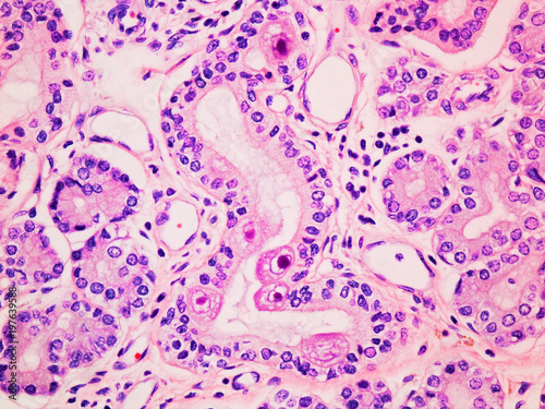 Cytomegalovirus CMV infection in the salivary gland viewed at 400x magnification with haemotoxylin and eosin staining photo