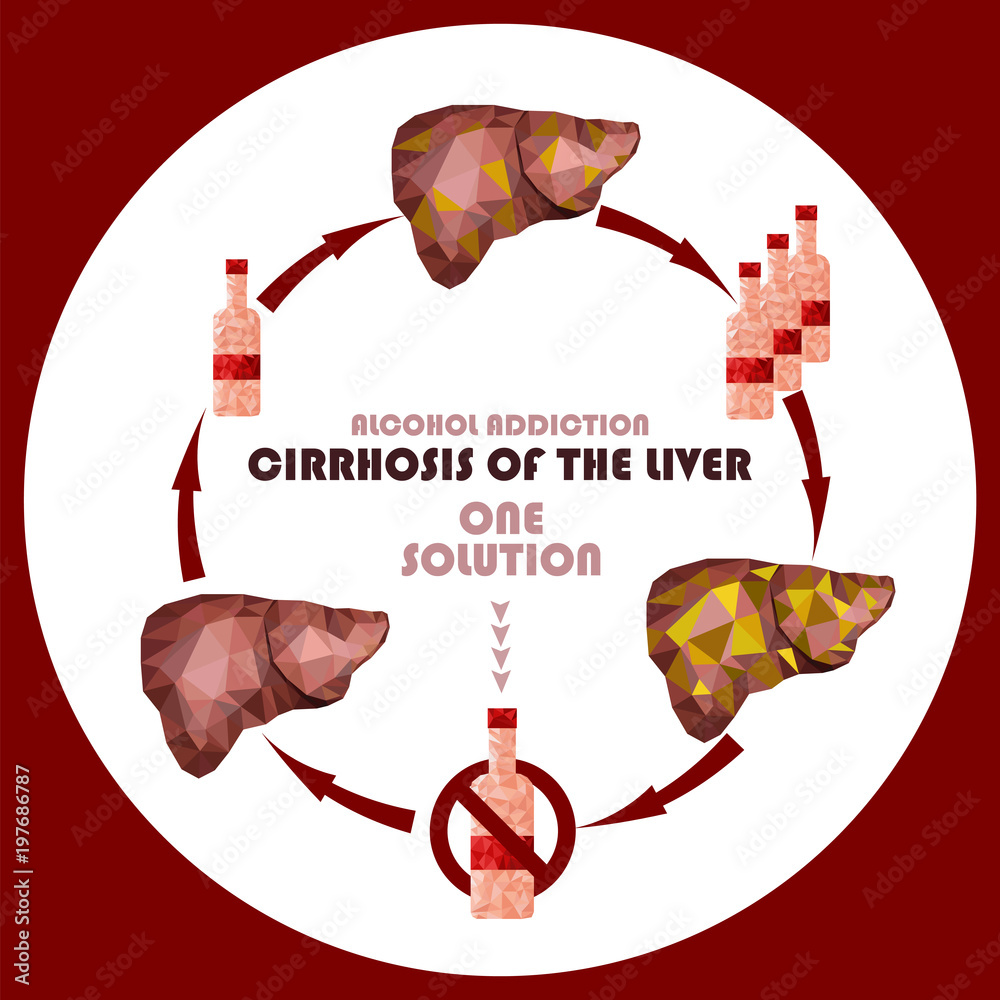 One Solution Against Liver Disease Concept Stop Drinking Alcohol Sign