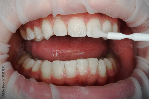  tooth fluoridation