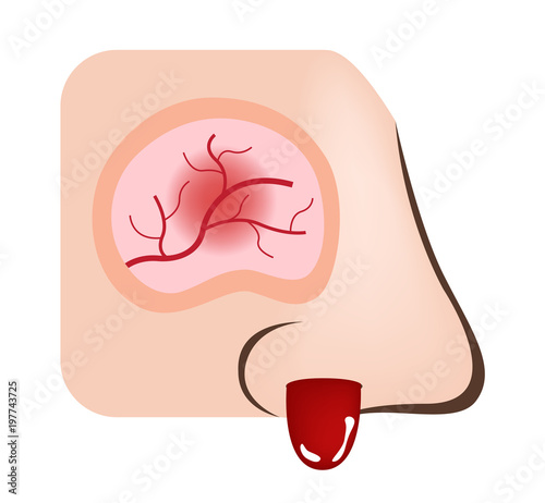 nose bleeding vector / inflamed nasal and sinus