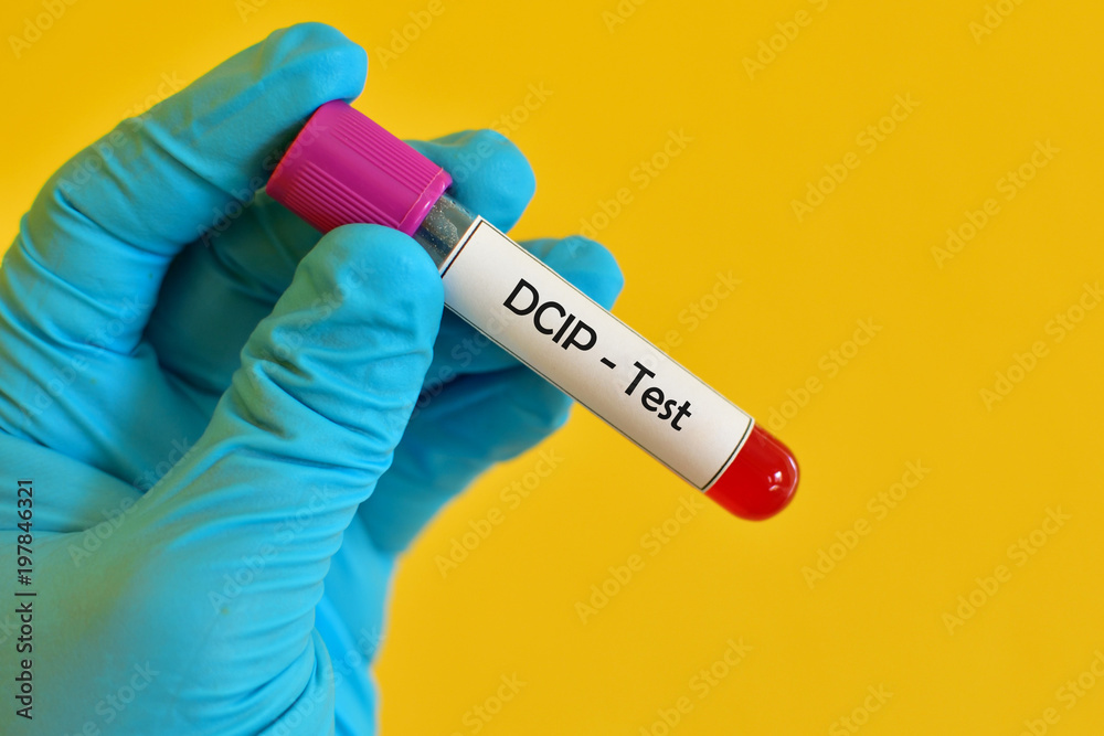 Fototapeta premium Test tube with blood sample for DCIP (dichlorophenol indophenol precipitation) test, thalassemia diagnosis