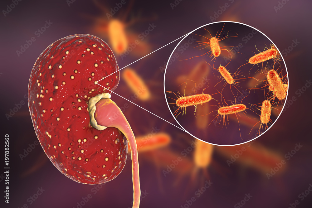 Acute pyelonephritis, medical concept, and closeup view of bacteria