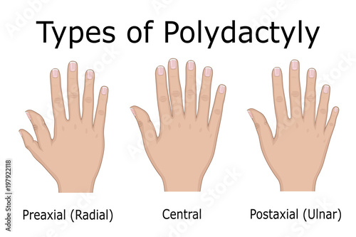 Illustration of Types of Polydactyly