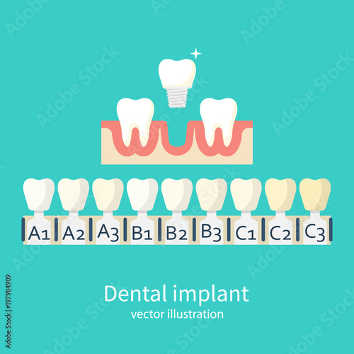 Shades of implants. Denture and implant production, teeth color samples. Veneers. Implant dental. Vector illustration flat design. Isolated on white background.
