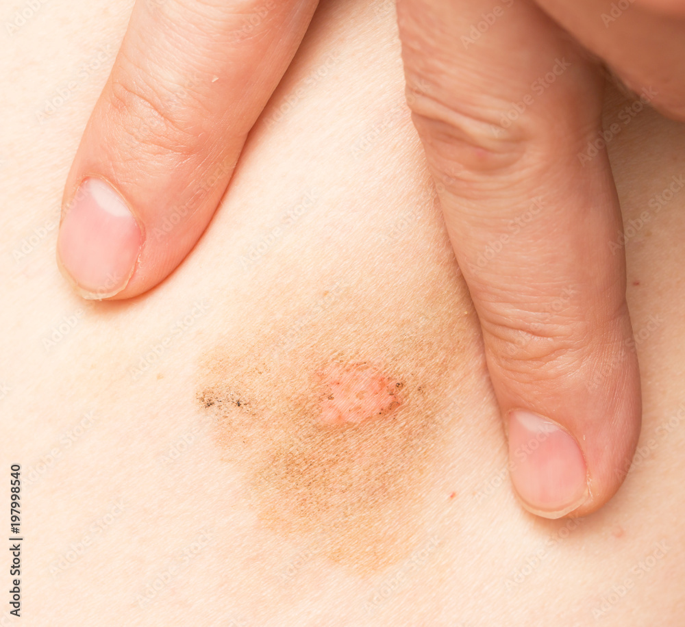 Ringworm on the body Ringworm on the body
