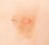 Ringworm on the body